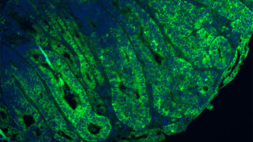 Green staining shows mTORC1 is significantly increased due to disruption in GATOR1 in a mouse model of colon cancer. Credit: Sumeet Solanki, Ph.D.