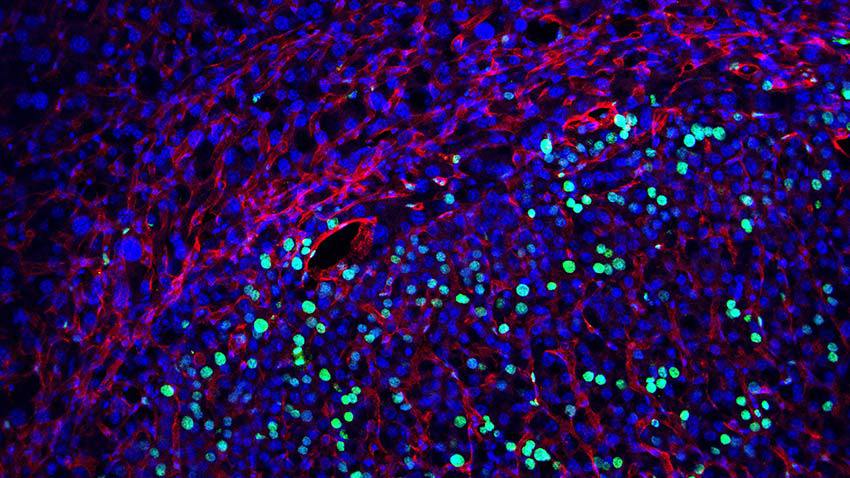 Normal liver tissue (top) and a liver cancer nodule (bottom) containing many dividing cells (labeled in green). Red color indicates blood vessels. Jiandie Lin, Ph.D., University of Michigan Life Sciences Institute