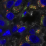 This sample of clinical triple-negative breast cancer is stained for bone morphogenetic protein-11 (red); the Golgi marker GM130 (green); glycosylated proteins (white); and nuclei (blue), illustrating profound molecular heterogeneity.