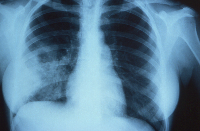 Anteroposterior (AP) x-ray shows signs of non-encapsulated pulmonary cryptococcosis in a human patient infected with Cryptococcus sp. fungal organisms.