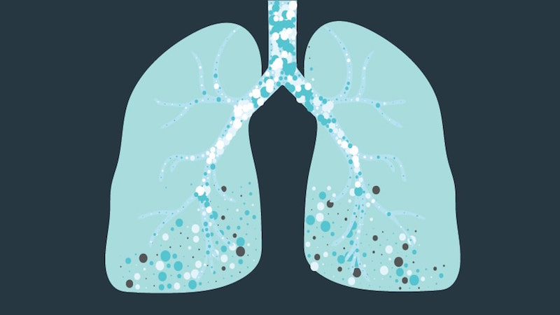 Illustration depicts scarring from idiopathic pulmonary fibrosis