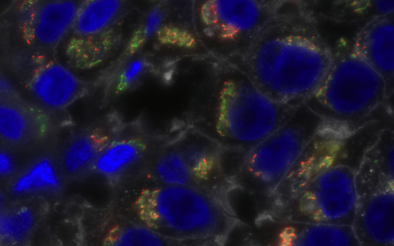 This sample of clinical triple-negative breast cancer is stained for bone morphogenetic protein-11 (red); the Golgi marker GM130 (green); glycosylated proteins (white); and nuclei (blue)