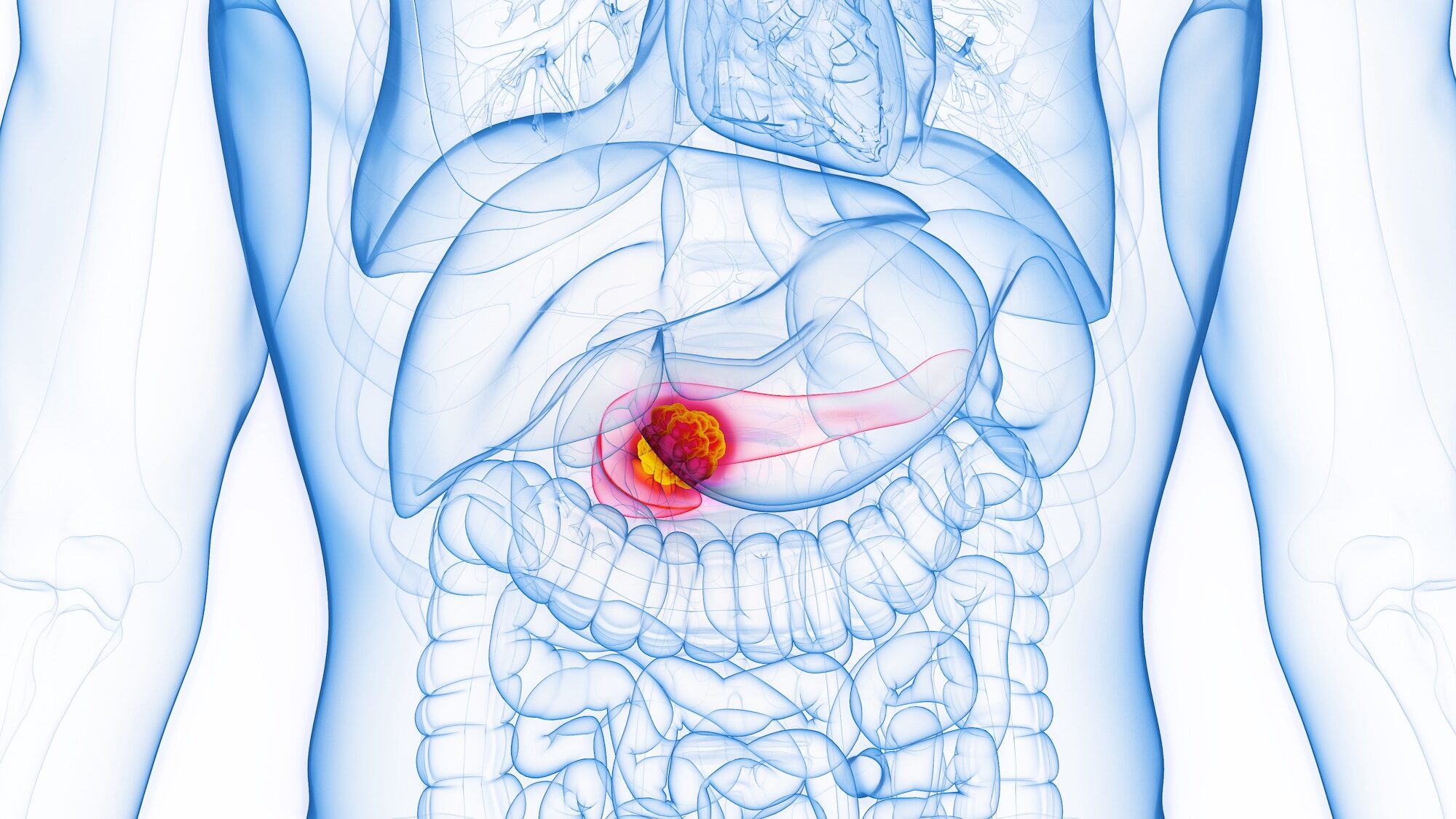 3D rendered Medical Illustration of Male Anatomy - Pancreatic Cancer. Plain White Background.