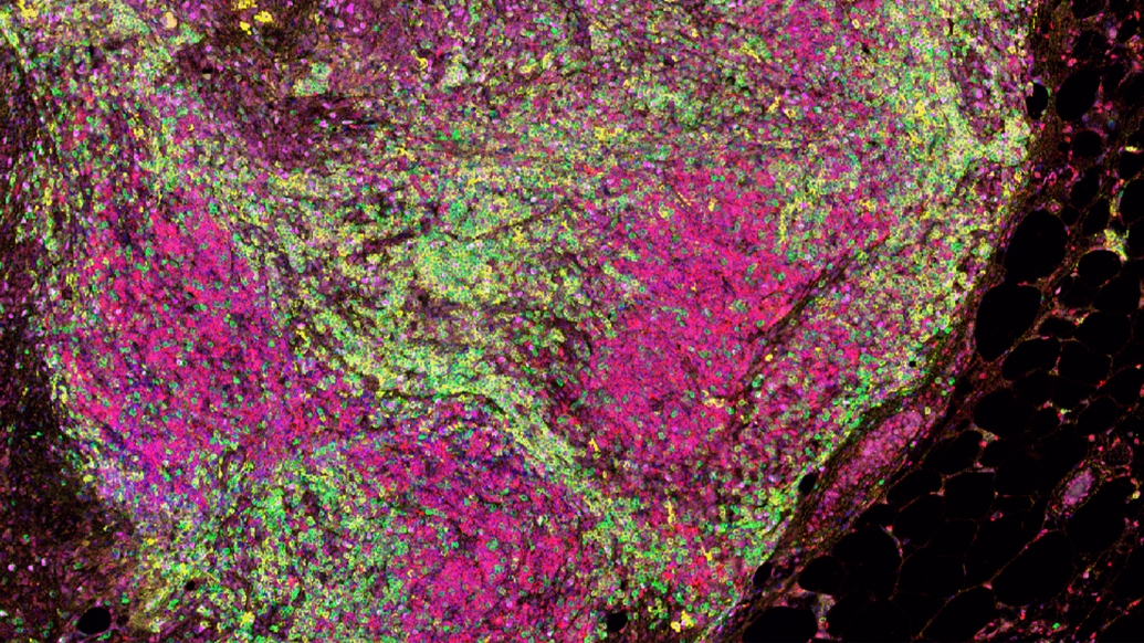 A microscopic close-up view of a liposarcoma tumor from the mouse model stained green and pink. Each color represents a different type of immune cell.